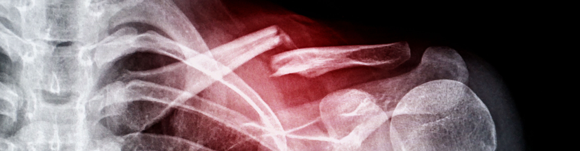 severe-bone-fracture