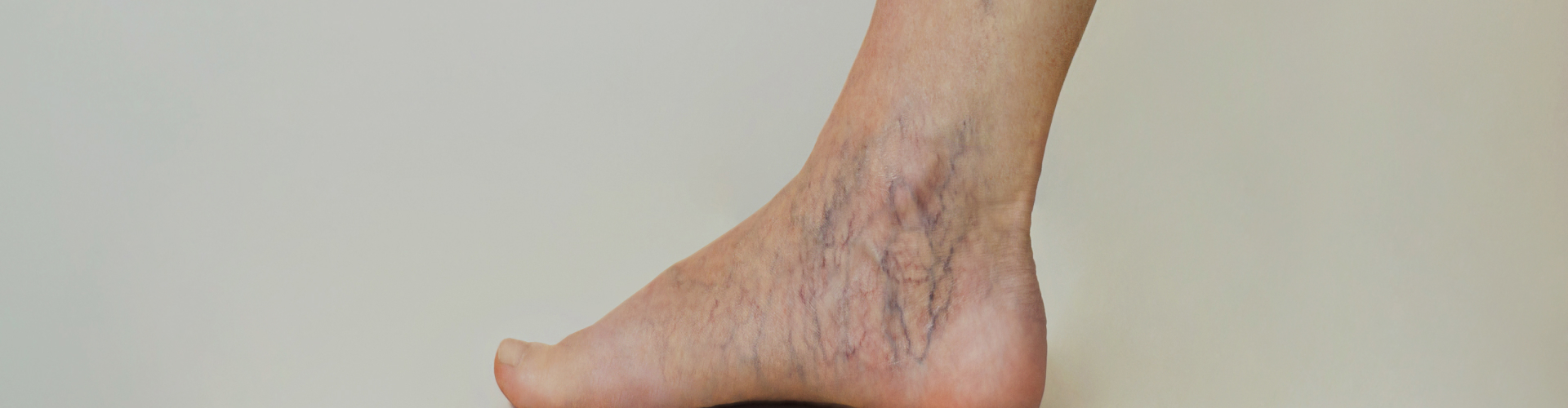 Varicose Veins Laser Surgery