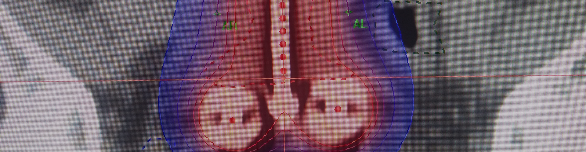 Radiation therapy for bladder cancer