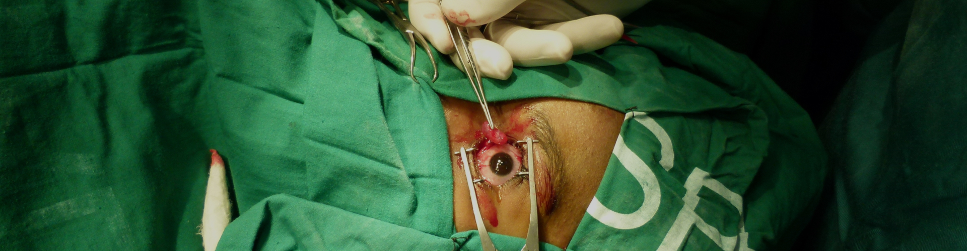 Conjunctiva Cyst Removal