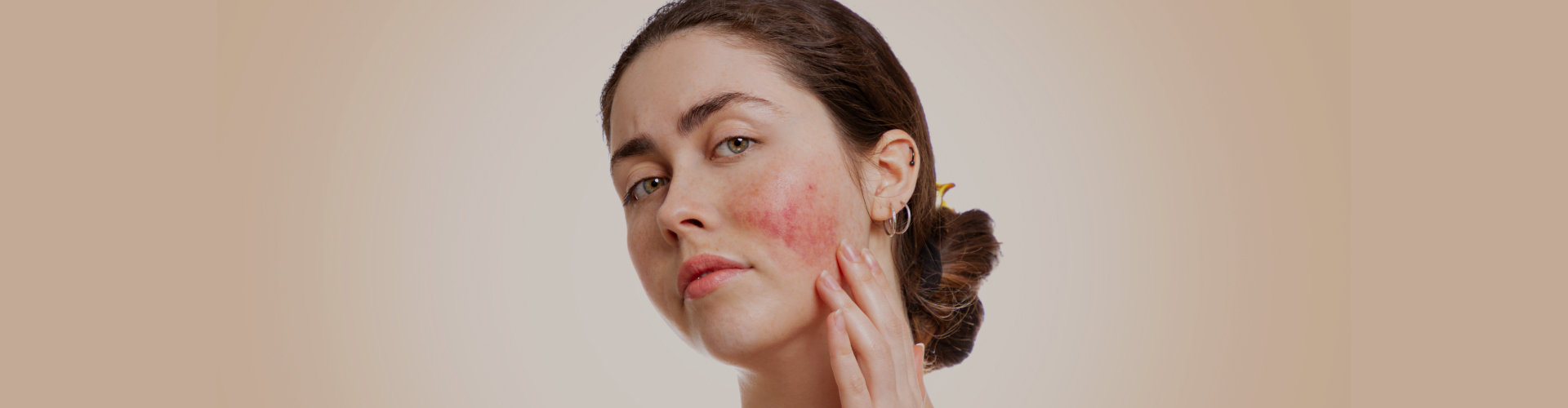 Rosacea