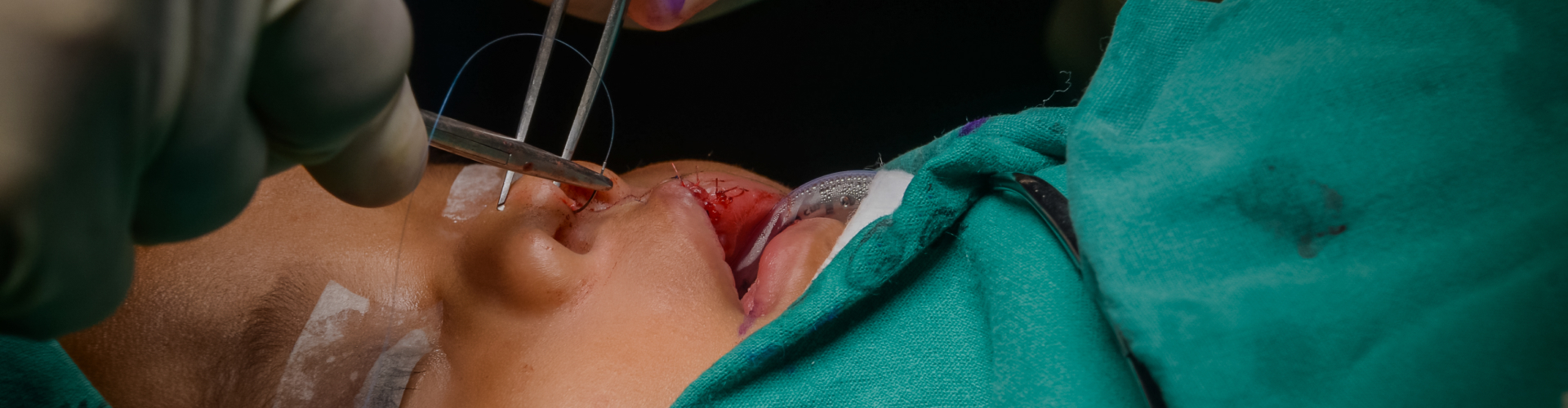 Cleft Lip or Cleft Palate Surgery