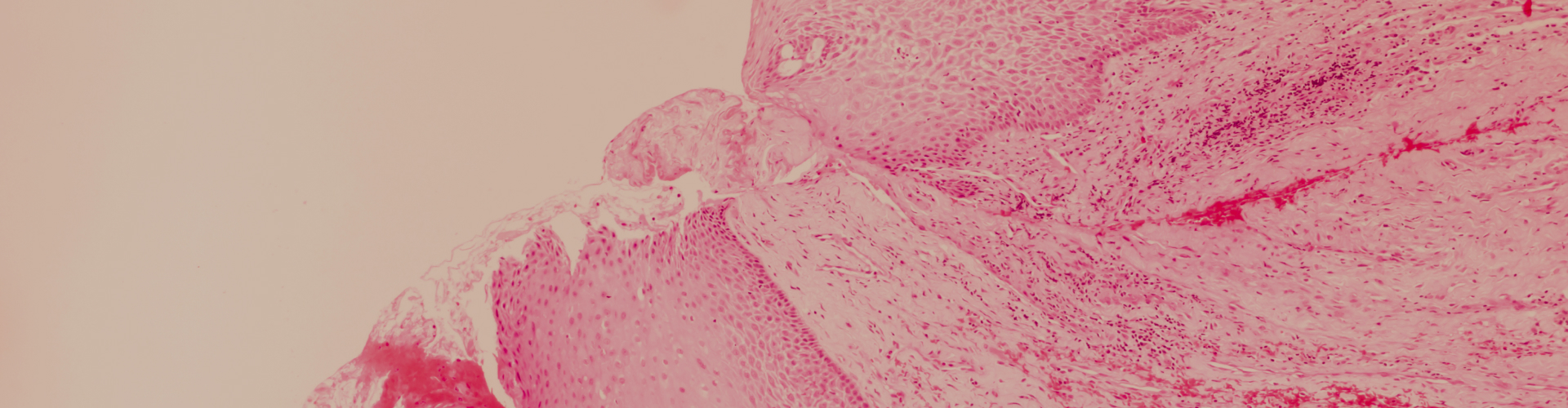 Carcinoma Rectum