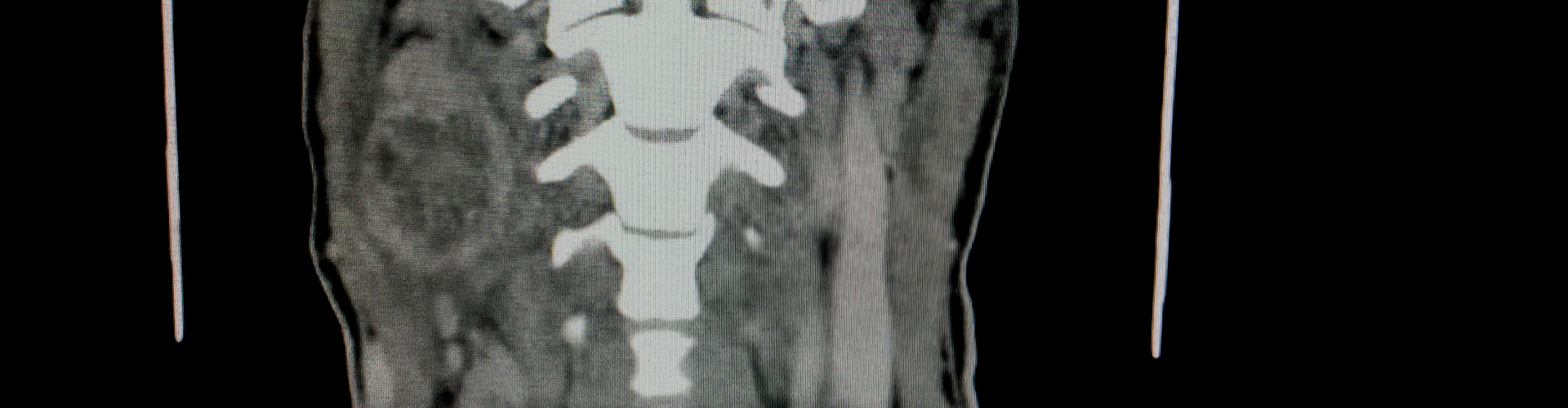 Intradural Spinal Tumour