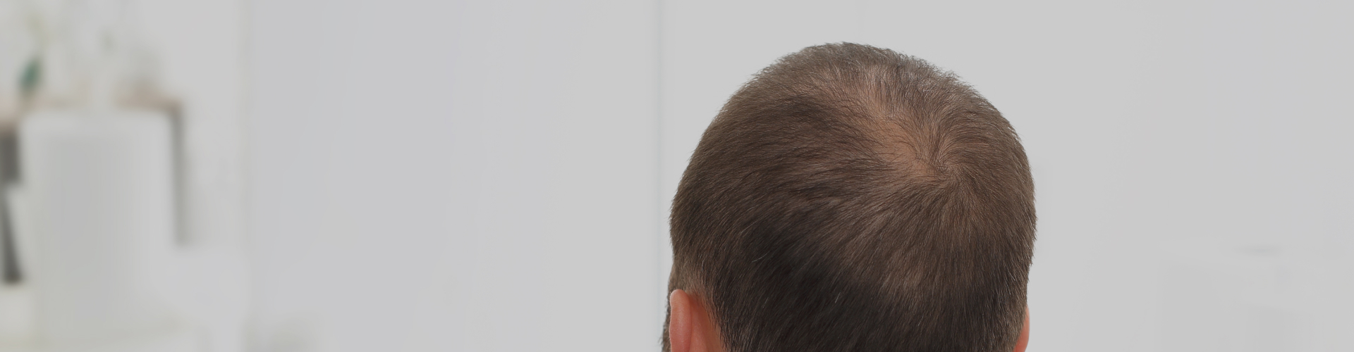 Androgenetic Alopecia or Pattern Baldness