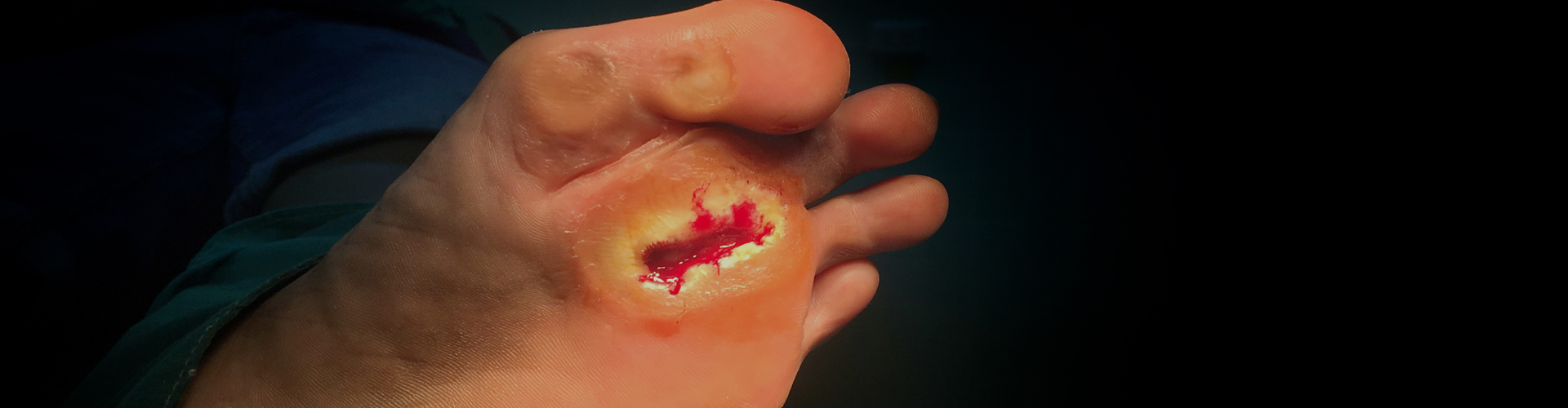 Diabetic foot Debridement