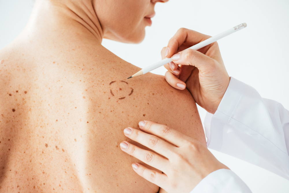 Understanding Melanoma: Symptoms, Causes, and Treatment