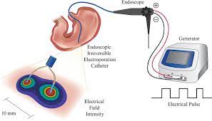 Medanta Pioneers the Irreversible Electroporation Technology to Treat Cancer Patients Unfit for Surgery