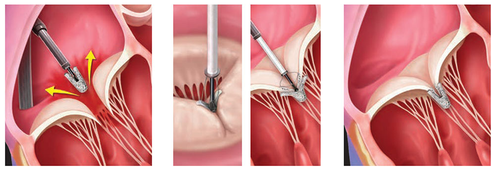 Asia’s First Tricuspid Valve Clipping Treatment 