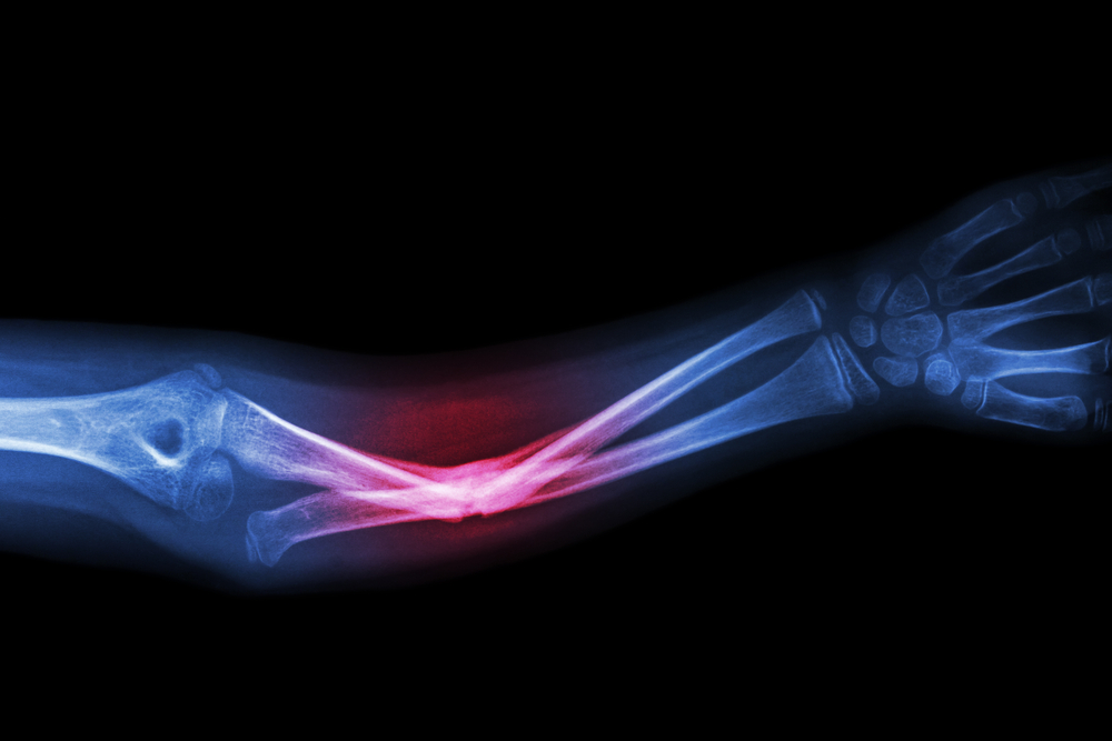 Diagnosis of bone fractures and any kind of muscle ruptures