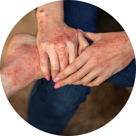 Eczema