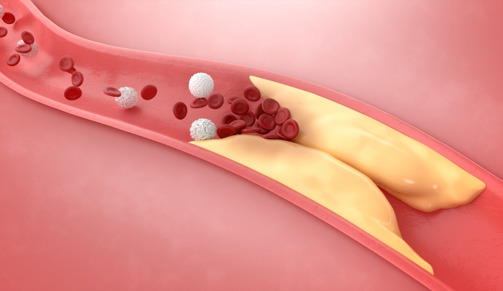 coronary-artery-disease