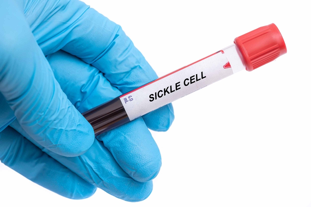 Sickle cell anemia