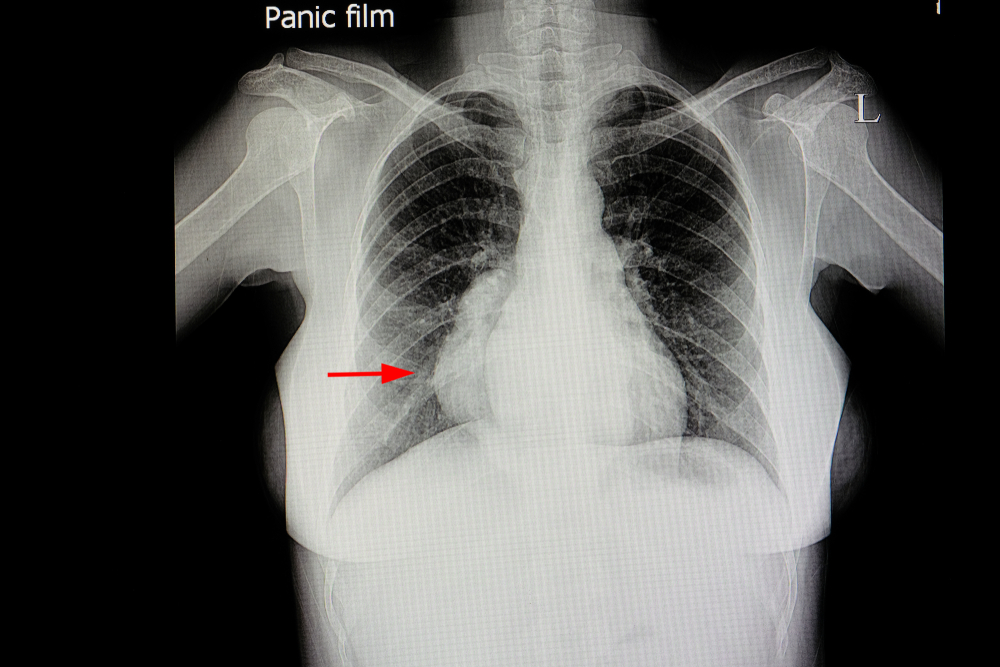 Posterior Mediastinal Tumours