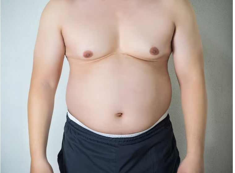 Gynecomastia