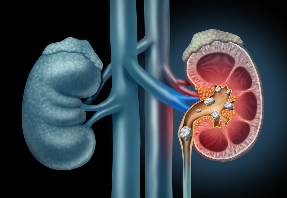 ENDOUROLOGY AND STONE DISEASE