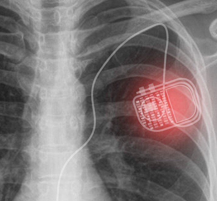 Implantable Cardioverter Defibrillator (ICD) Placement