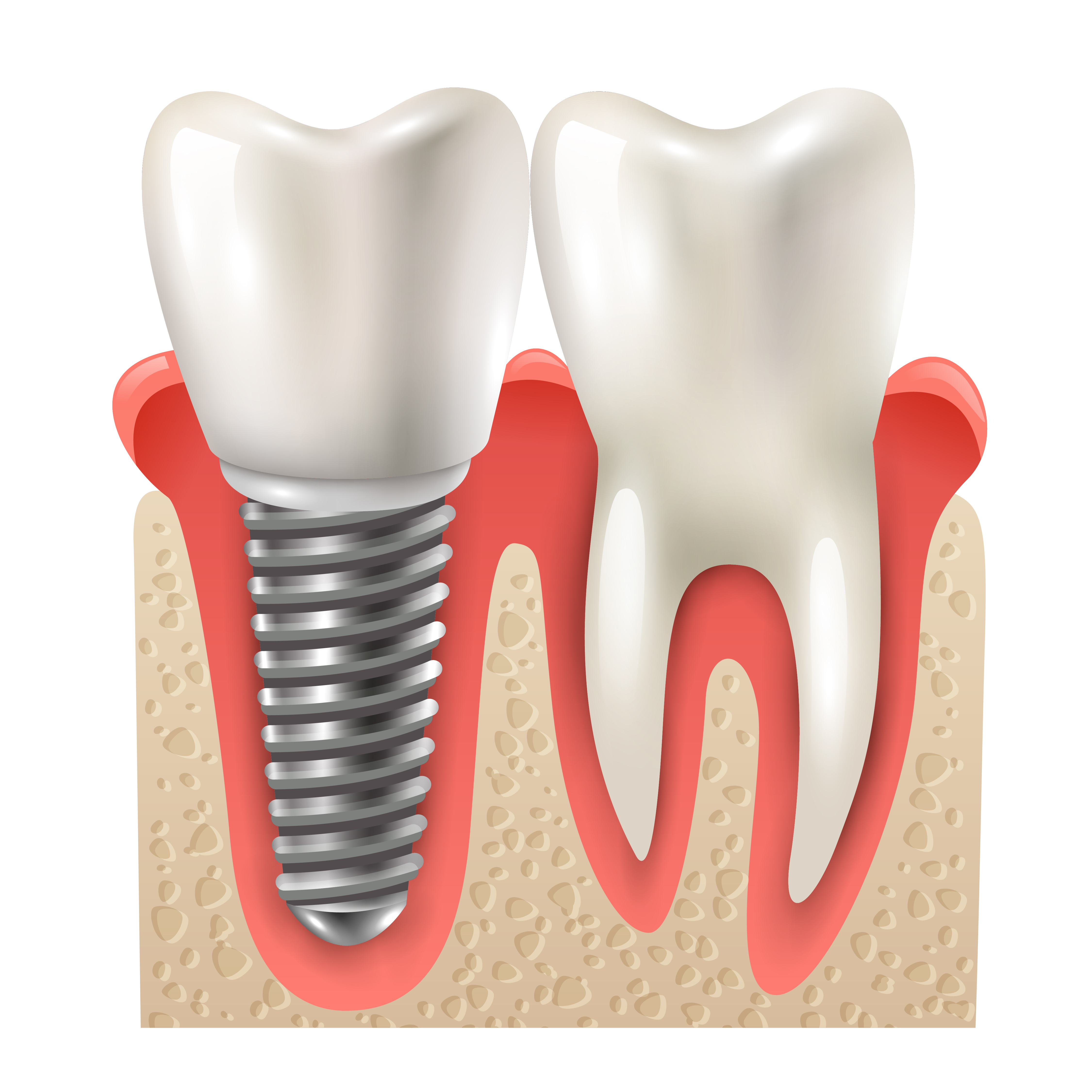 Full Mouth Implant