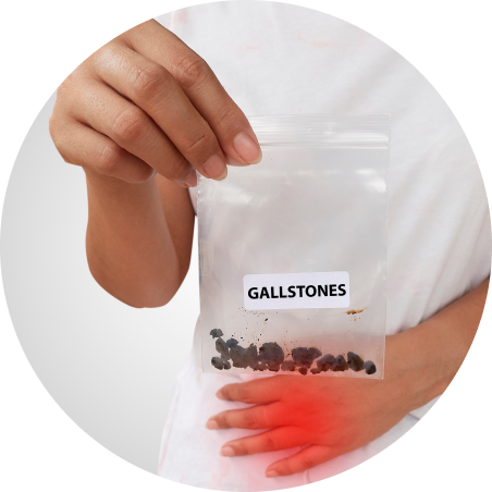 Gallstones