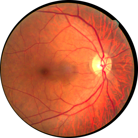 Retinal Disorders